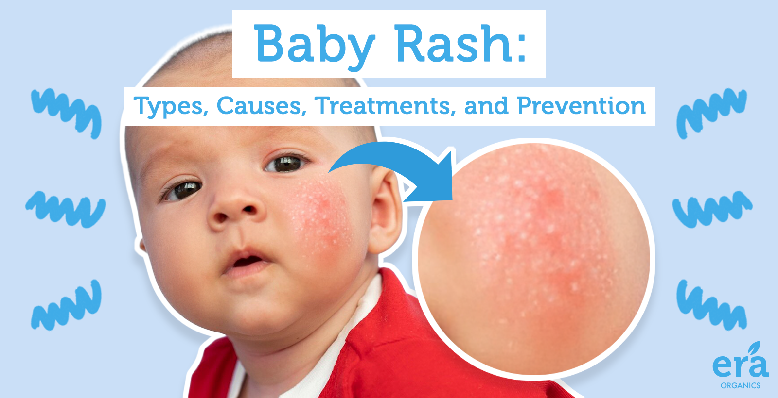Baby Rash: Types, Causes, Treatments, and Prevention – Era Organics