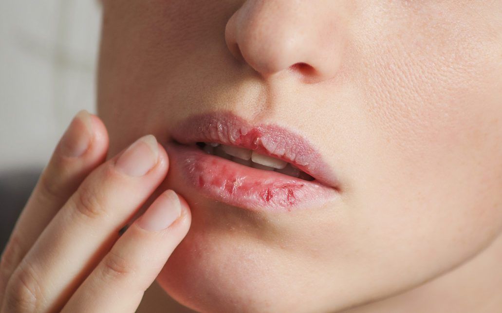 semaglutide chapped lips How to get rid of chapped lips quickly – Era Organics semaglutide chapped lips How to get rid of chapped lips quickly – Era Organics