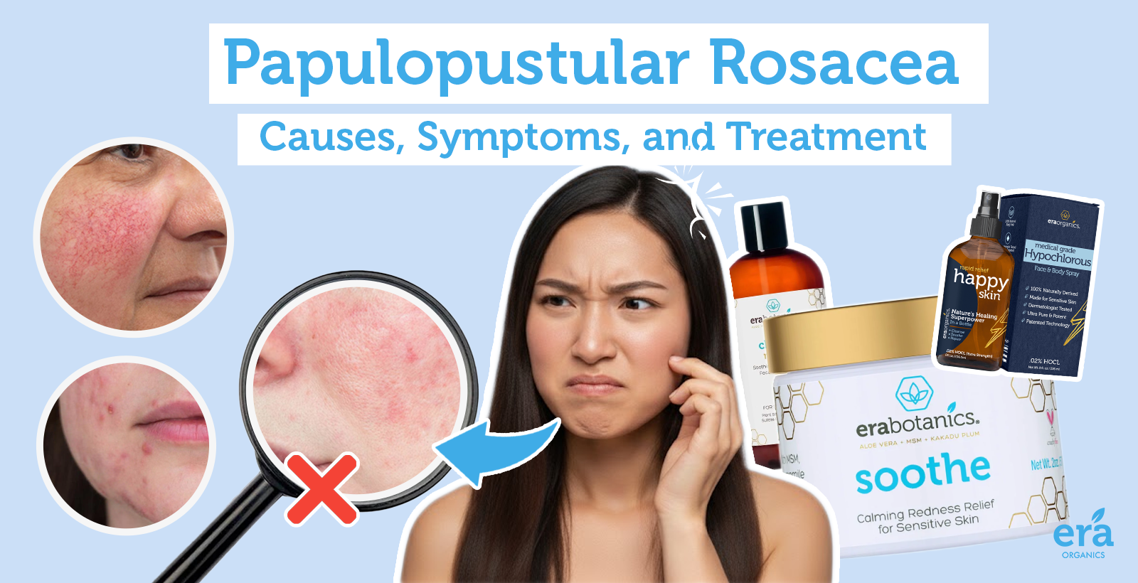 Papulopustular Rosacea: Causes, Symptoms, and Treatment  Era Organics