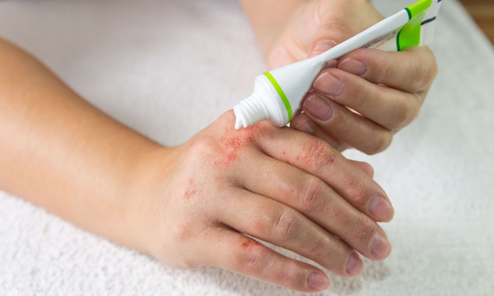 Is your eczema cream making your eczema worse