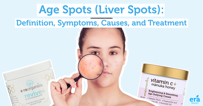 aging spots