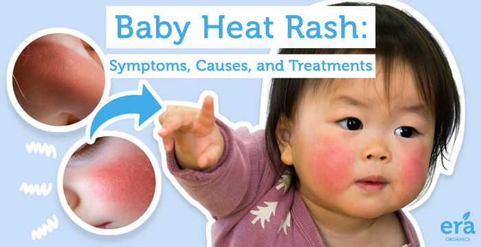 Baby Heat Rash: Symptoms, Causes, and Treatments