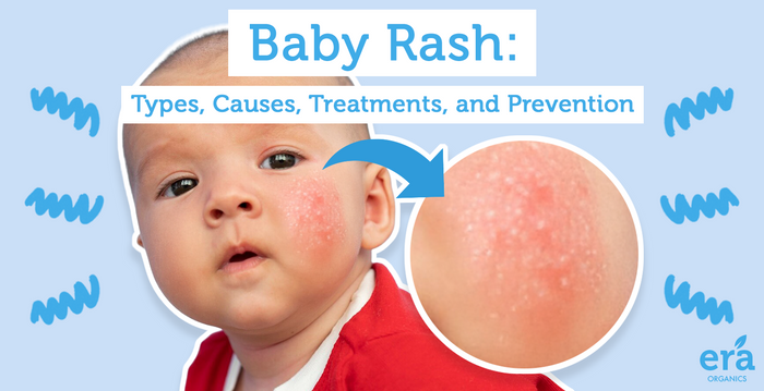 baby rash