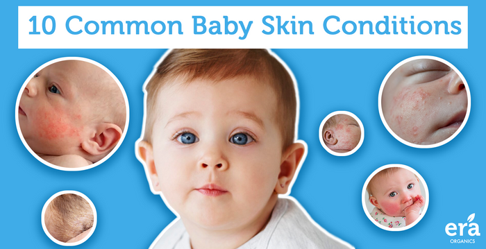 10 Common Baby Skin Conditions