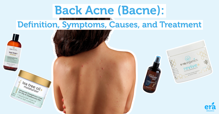 Back Acne (Bacne): Definition, Symptoms, Causes, and Treatment