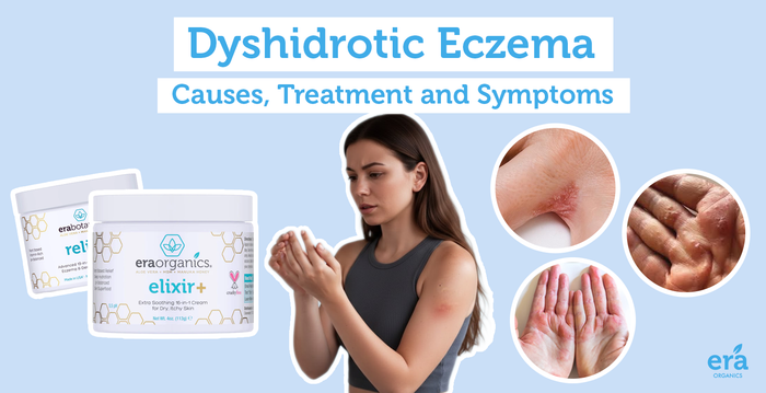 Dyshidrotic Eczema: Causes, Treatment and Symptoms