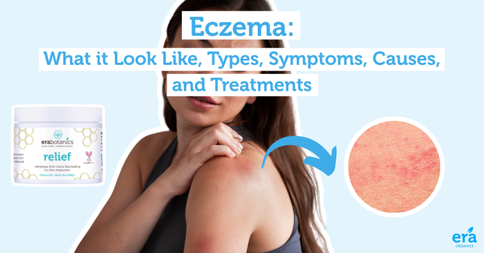 How to get rid of eczema