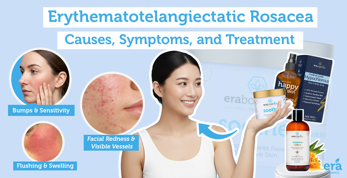 Erythematotelangiectatic Rosacea: Causes, Symptoms, and Treatment
