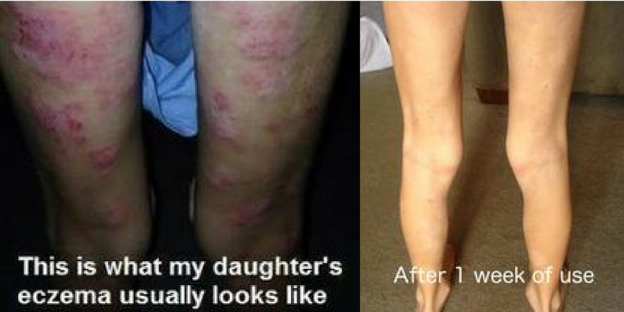 eczema treatment before and after