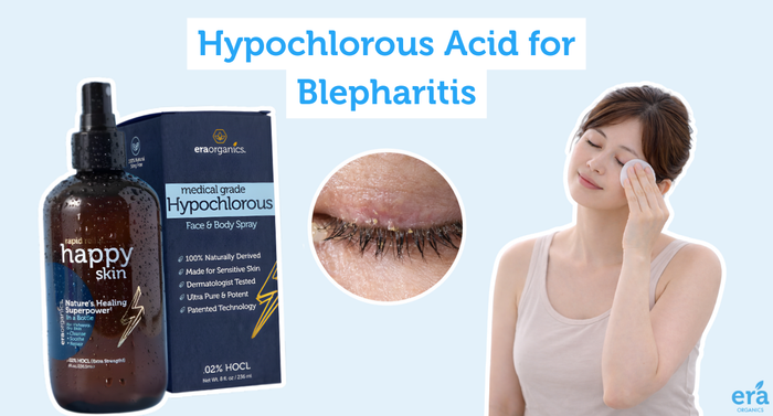 Hypochlorous acid for Blepharitis
