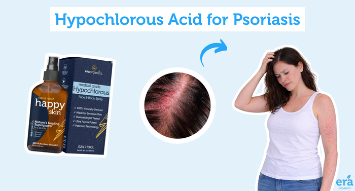 Hypochlorous Acid for Psoriasis