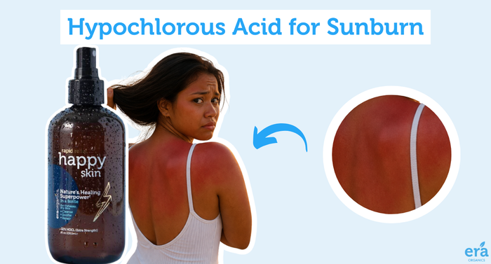 Hypochlorous Acid for Sunburn