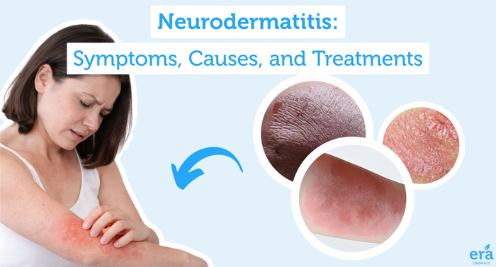 Neurodermatitis: Symptoms, Causes and Treatments
