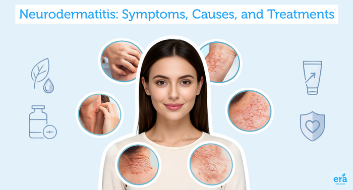 Neurodermatitis: Symptoms, Causes and Treatments