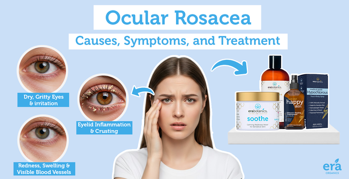 Ocular Rosacea