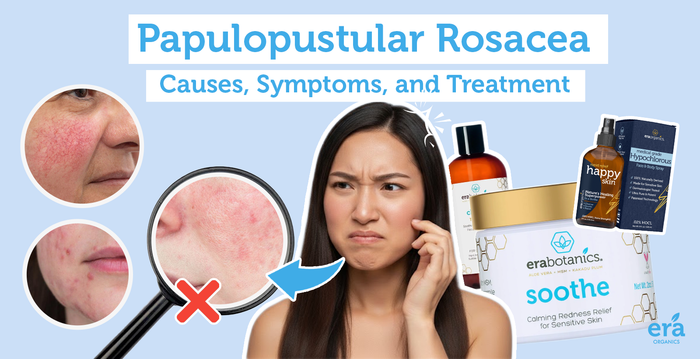 Papulopustular Rosacea: Causes, Symptoms, and Treatment