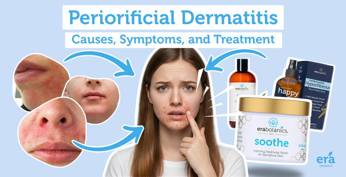 Periorificial Dermatitis: Causes, Symptoms, and Treatment
