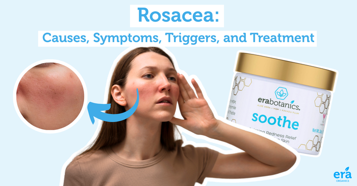 Rosacea: Causes, Symptoms, Triggers, and Treatment
