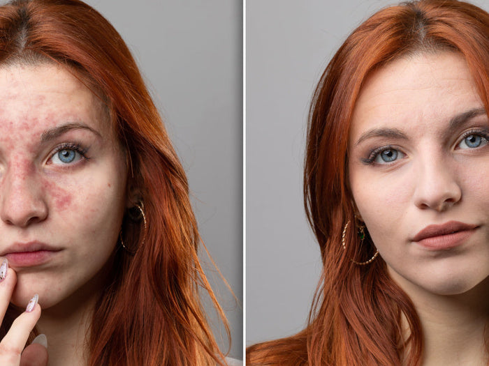 a women with acne on her face