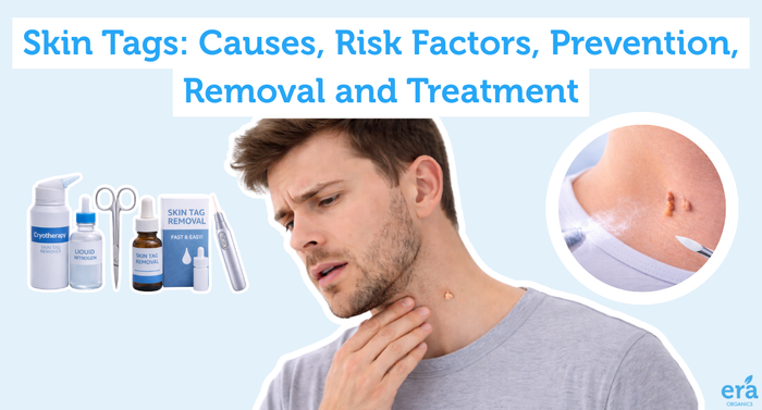Skin Tags: Causes, Risk Factors, Prevention, Removal and Treatment