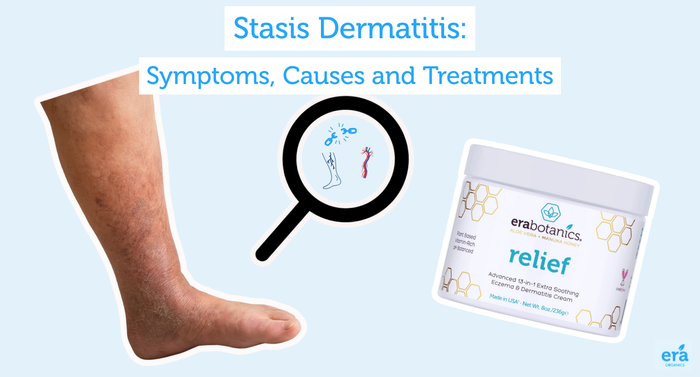 Stasis Dermatitis: Symptoms, Causes and Treatments