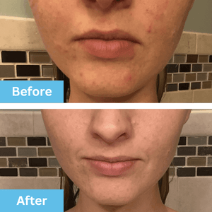 Buy the Best Hypochlorous Acid (HOCL) Spray for Face - Era Organics