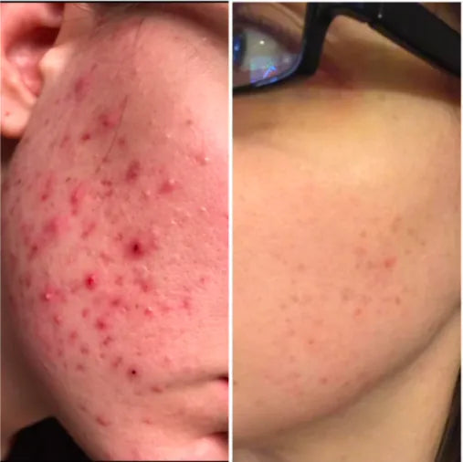 Before and after photos of a cheek with breakouts