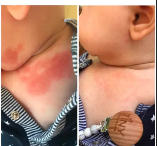 Before and after photos of a baby's neck